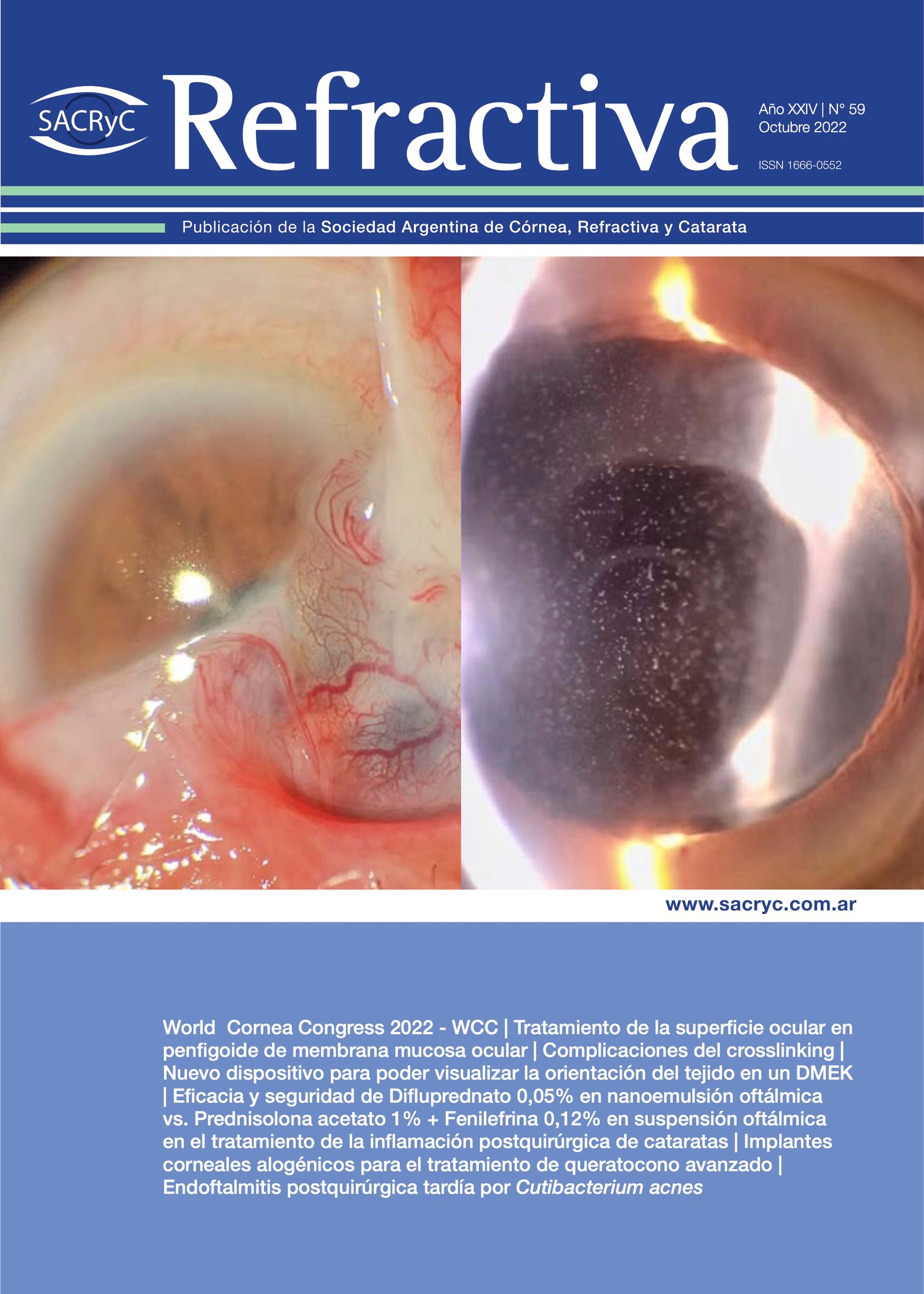 Tapa de Refractiva N.º 59